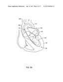 MEDICAL GUIDEWIRE diagram and image