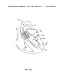 MEDICAL GUIDEWIRE diagram and image