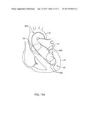 MEDICAL GUIDEWIRE diagram and image