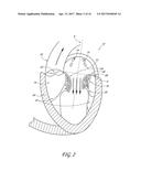 PERCUTANEOUS TRANSVALVULAR INTRAANNULAR BAND FOR MITRAL VALVE REPAIR diagram and image