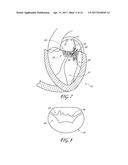 PERCUTANEOUS TRANSVALVULAR INTRAANNULAR BAND FOR MITRAL VALVE REPAIR diagram and image