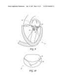 PERCUTANEOUS TRANSVALVULAR INTRAANNULAR BAND FOR MITRAL VALVE REPAIR diagram and image