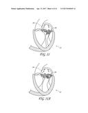 PERCUTANEOUS TRANSVALVULAR INTRAANNULAR BAND FOR MITRAL VALVE REPAIR diagram and image