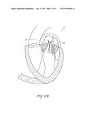 PERCUTANEOUS TRANSVALVULAR INTRAANNULAR BAND FOR MITRAL VALVE REPAIR diagram and image