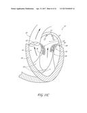 PERCUTANEOUS TRANSVALVULAR INTRAANNULAR BAND FOR MITRAL VALVE REPAIR diagram and image