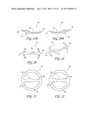 PERCUTANEOUS TRANSVALVULAR INTRAANNULAR BAND FOR MITRAL VALVE REPAIR diagram and image