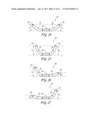 PERCUTANEOUS TRANSVALVULAR INTRAANNULAR BAND FOR MITRAL VALVE REPAIR diagram and image