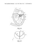 PERCUTANEOUS TRANSVALVULAR INTRAANNULAR BAND FOR MITRAL VALVE REPAIR diagram and image