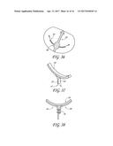 PERCUTANEOUS TRANSVALVULAR INTRAANNULAR BAND FOR MITRAL VALVE REPAIR diagram and image