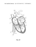 PERCUTANEOUS TRANSVALVULAR INTRAANNULAR BAND FOR MITRAL VALVE REPAIR diagram and image