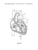 PERCUTANEOUS TRANSVALVULAR INTRAANNULAR BAND FOR MITRAL VALVE REPAIR diagram and image