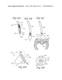 PERCUTANEOUS TRANSVALVULAR INTRAANNULAR BAND FOR MITRAL VALVE REPAIR diagram and image