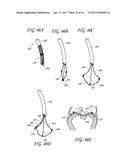 PERCUTANEOUS TRANSVALVULAR INTRAANNULAR BAND FOR MITRAL VALVE REPAIR diagram and image