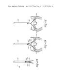 PERCUTANEOUS TRANSVALVULAR INTRAANNULAR BAND FOR MITRAL VALVE REPAIR diagram and image