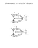 PERCUTANEOUS TRANSVALVULAR INTRAANNULAR BAND FOR MITRAL VALVE REPAIR diagram and image