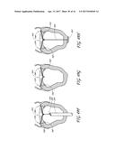 PERCUTANEOUS TRANSVALVULAR INTRAANNULAR BAND FOR MITRAL VALVE REPAIR diagram and image