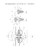 SYSTEM AND METHOD FOR REPAIRING ARTICULAR SURFACES diagram and image