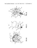 SYSTEM AND METHOD FOR REPAIRING ARTICULAR SURFACES diagram and image