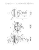 SYSTEM AND METHOD FOR REPAIRING ARTICULAR SURFACES diagram and image