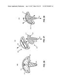 SYSTEM AND METHOD FOR REPAIRING ARTICULAR SURFACES diagram and image