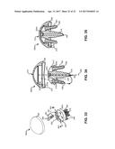 SYSTEM AND METHOD FOR REPAIRING ARTICULAR SURFACES diagram and image