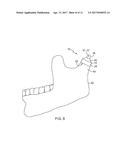 TEMPOROMANDIBULAR JOINT IMPLANTS AND METHODS OF TREATING A     TEMPOROMANDIBULAR JOINT diagram and image