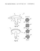 DESIGN OF AN IMPLANT FOR CARTILAGE REPAIR diagram and image