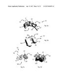 DESIGN OF AN IMPLANT FOR CARTILAGE REPAIR diagram and image