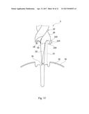 DESIGN OF AN IMPLANT FOR CARTILAGE REPAIR diagram and image