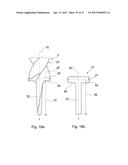 DESIGN OF AN IMPLANT FOR CARTILAGE REPAIR diagram and image