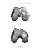 DESIGN OF AN IMPLANT FOR CARTILAGE REPAIR diagram and image