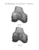 DESIGN OF AN IMPLANT FOR CARTILAGE REPAIR diagram and image