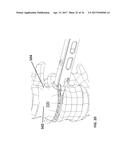 INSERTION TOOL FOR IMPLANT AND METHODS OF USE diagram and image