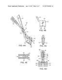 METHODS AND APPARATUS FOR INTERVERTEBRAL DISC PROSTHESIS INSERTION diagram and image