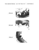 STENTS HAVING PROTRUDING DRUG-DELIVERY FEATURES AND ASSOCIATED SYSTEMS AND     METHODS diagram and image