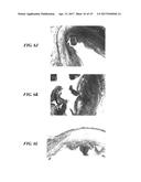 STENTS HAVING PROTRUDING DRUG-DELIVERY FEATURES AND ASSOCIATED SYSTEMS AND     METHODS diagram and image