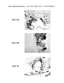 STENTS HAVING PROTRUDING DRUG-DELIVERY FEATURES AND ASSOCIATED SYSTEMS AND     METHODS diagram and image