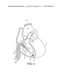 INTRACARDIAC MEDICAL DEVICE WITH PRESSURE SENSING diagram and image