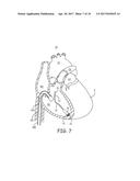 INTRACARDIAC MEDICAL DEVICE WITH PRESSURE SENSING diagram and image