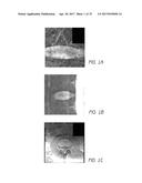 MR SPECTROSCOPY SYSTEM AND METHOD FOR DIAGNOSING PAINFUL AND NON-PAINFUL     INTERVERTEBRAL DISCS diagram and image