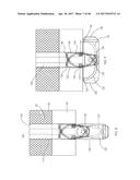 Apparatus and method for fascial closure device for laparoscopic trocar     port site and surgery diagram and image