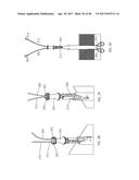 Apparatus and method for fascial closure device for laparoscopic trocar     port site and surgery diagram and image