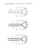 Apparatus and method for fascial closure device for laparoscopic trocar     port site and surgery diagram and image