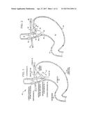 SLITTED TISSUE FIXATION DEVICES AND ASSEMBLIES FOR DEPLOYING THE SAME diagram and image