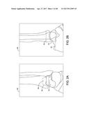 SYSTEM AND METHOD FOR ANTERIOR APPROACH FOR INSTALLING TIBIAL STEM diagram and image