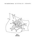 UTERINE MANIPULATOR diagram and image