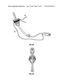 UTERINE MANIPULATOR diagram and image