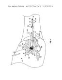 UTERINE MANIPULATOR diagram and image