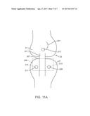 Implantable Assembly for a Knee Joint and Method for Mounting an     Implantable Assembly for a Knee Joint diagram and image