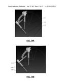 Spondylisthesis Reduction System diagram and image